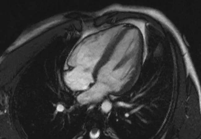 heart affected by hypertrophic cardiomyopathy