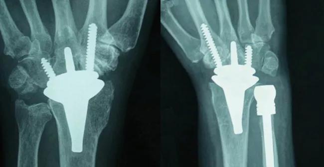 Inset-Orthopaedics