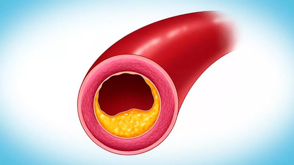 atherosclerosis in coronary artery