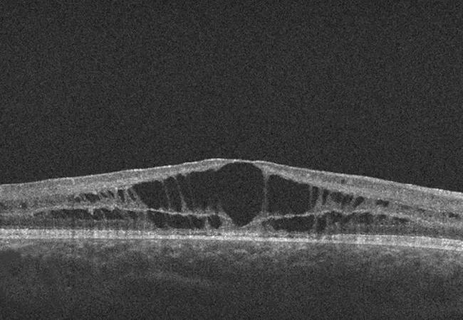 22-EYE-3391159 CQD-Treating Retinoschisis-hero