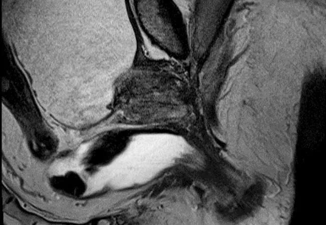 650&#215;450-Prostate-Brachytherapy