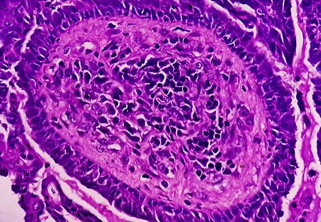 endometrial cancer