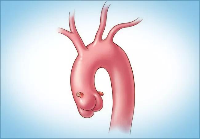 23-HVI-4003412_aorta-illustration_650x450