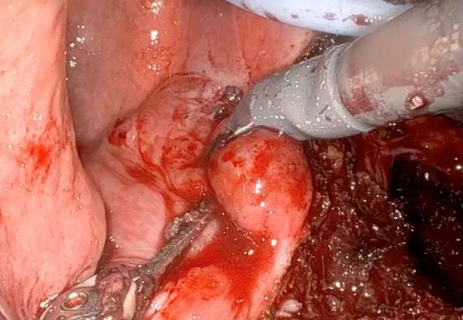 uterteral endometriosis