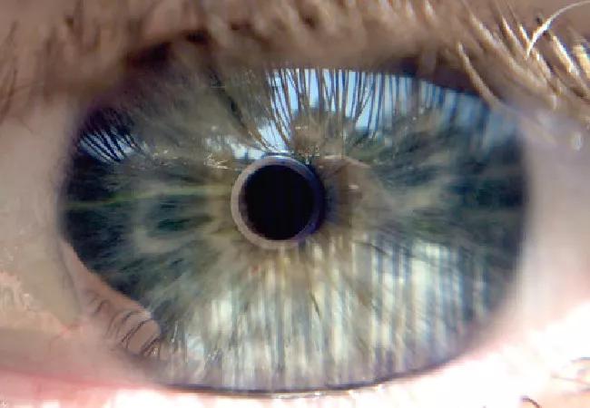 Cornea closeup