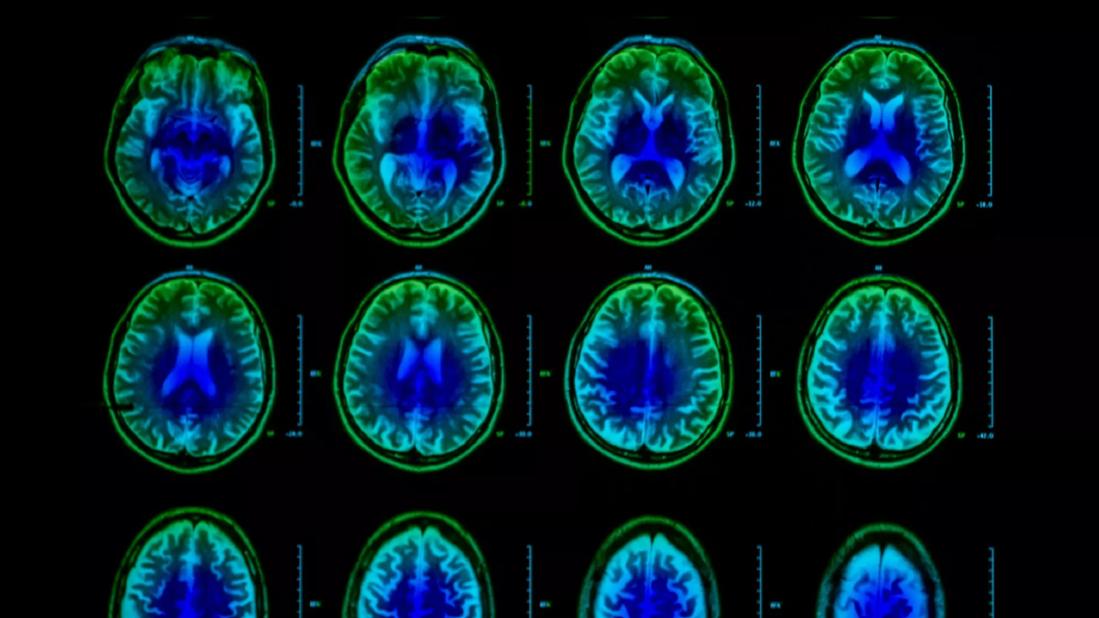 18-NEU-509-Nakamura-Volumetric-MRI-650&#215;450