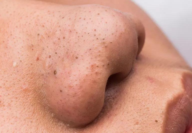 blackheads in skin on face