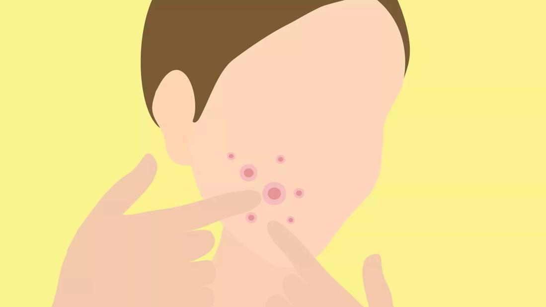 An illustration of someone with pimples on their face trying to pop one