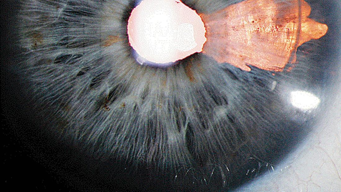 Uveitis caused by a viral infection