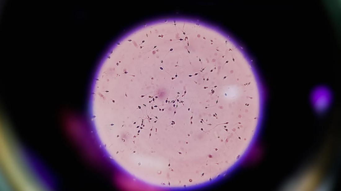 Sperm analysis on microscopic examination