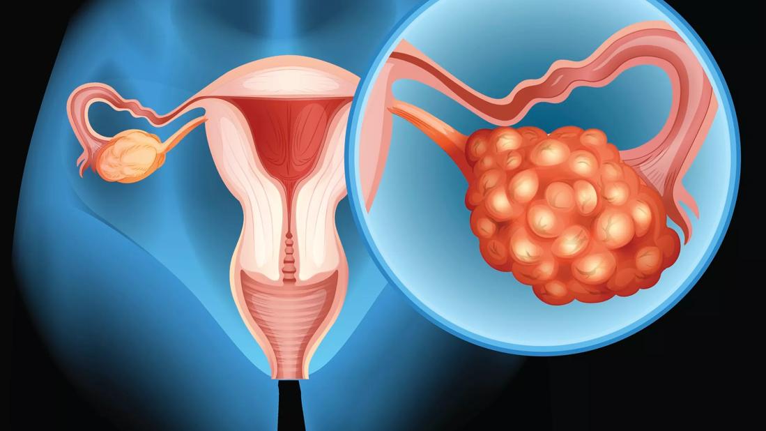 Les résultats de la recherche de la Cleveland Clinic pourraient améliorer le traitement du cancer de l’ovaire résistant à la chimiothérapie