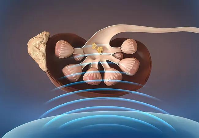 Kidney lithotripsy procedure Etracorporeal shock wave lithotripsy for remove