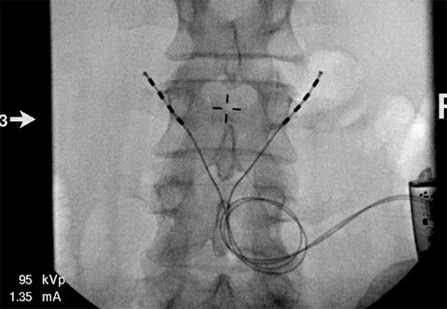 ReActiv8 neurostimulation device