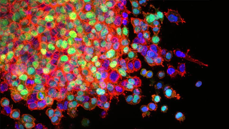 Lung cancer cells