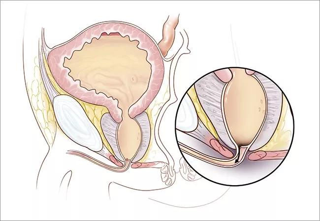 650&#215;450-Posterior-Urethral-Valve