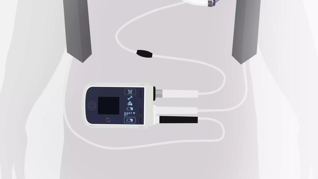 Left Ventricular Assist Device Therapy