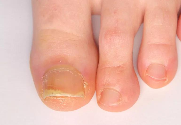 psoriatic arthritis affect on toenails