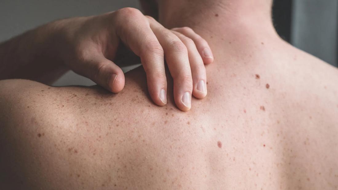 A person's back, covered in moles and freckles, with their hand reaching over their shoulder