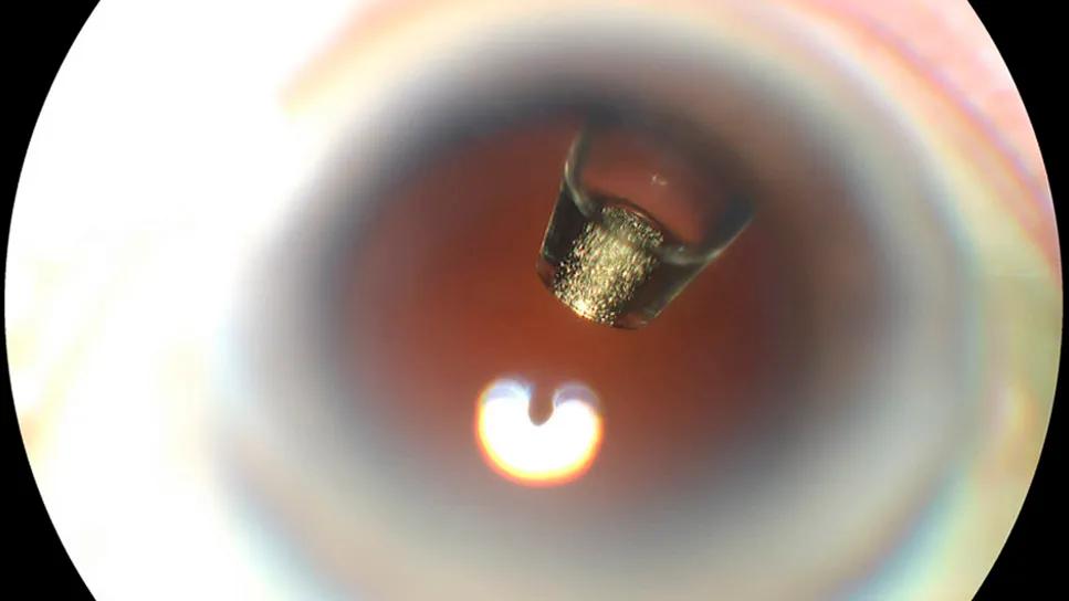 Ranibizumab port delivery system inside an eye