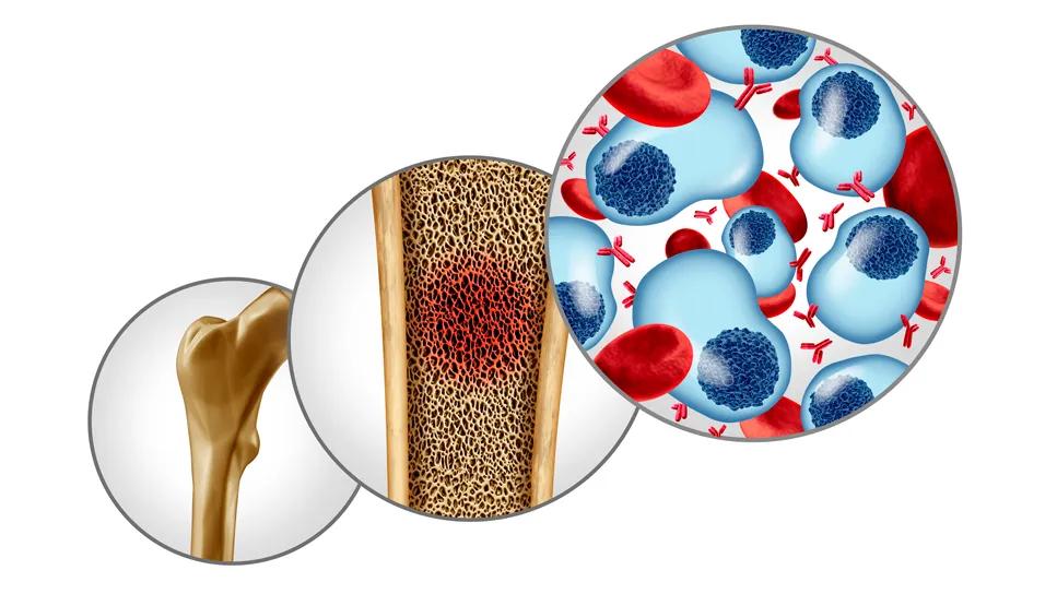 Multiple myeloma cell