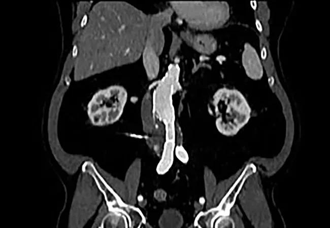 19-HRT-3824-abdominal-aortic-aneurysm_650x450