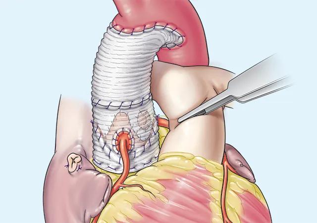 completed aortic root replacement with reimplantation