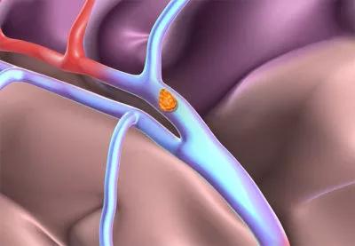 23-NEU-4479131-thrombolysis-ischemic-stroke-650&#215;450