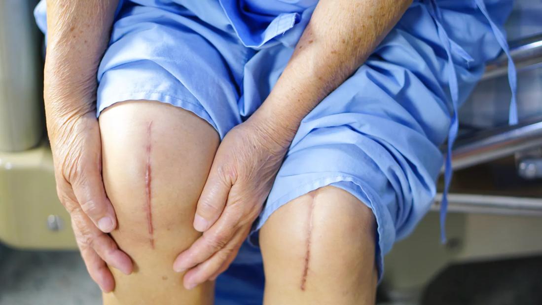 Should You Have Both Knees Replaced at the Same Time?