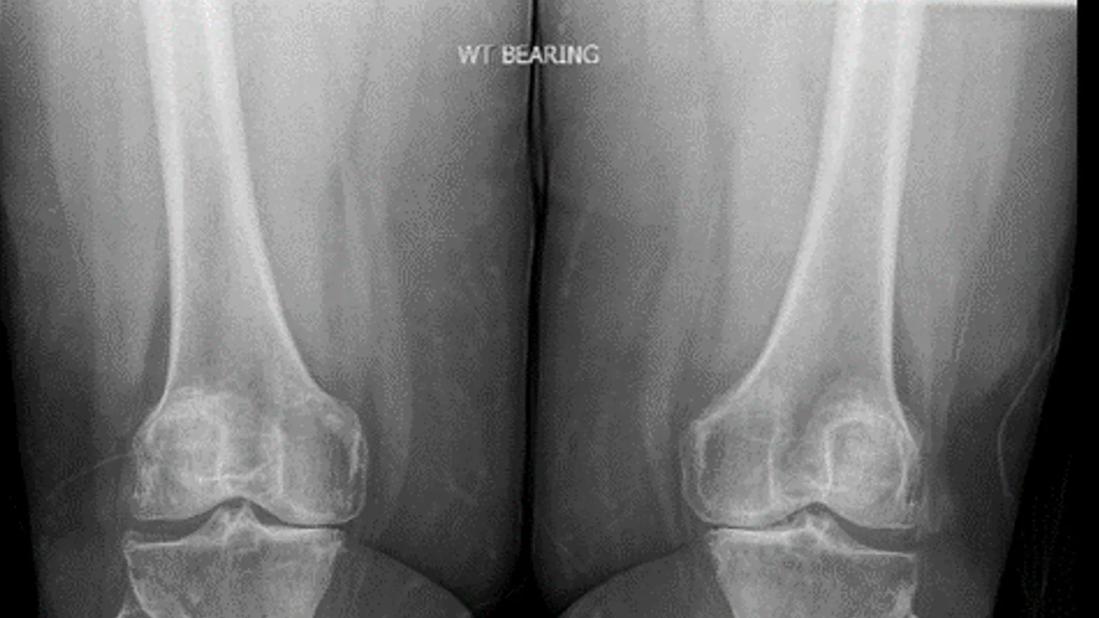 once-weekly semaglutide in persons with obesity and knee osteoarthritis tirzepatide SEMAGLUTIDE SHOWS POTENTIAL TO REVERSE – Osteoarthritis: Ozempic, Wegovy may help