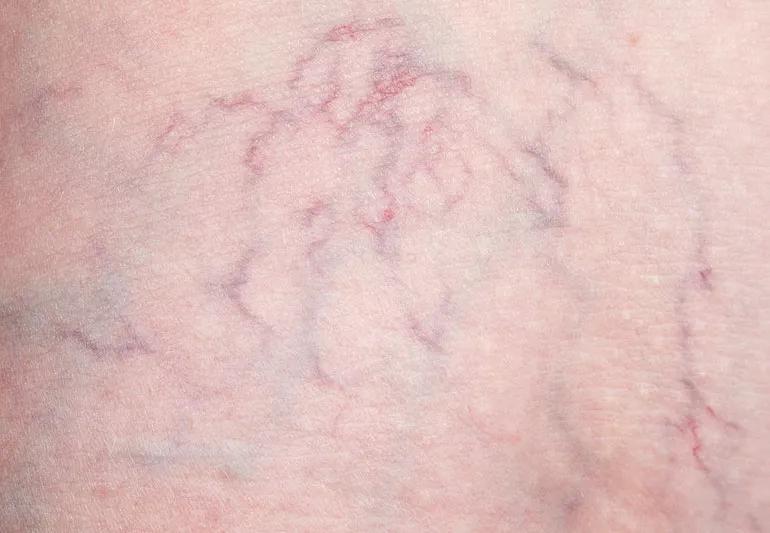 Closeup of spider veins on leg.