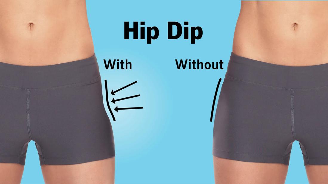 Two photos of a lower body: one with hip dips, an inward curve between hips and thighs; the other without hip dips