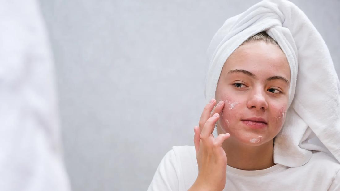 Young woman putting face cream on acne