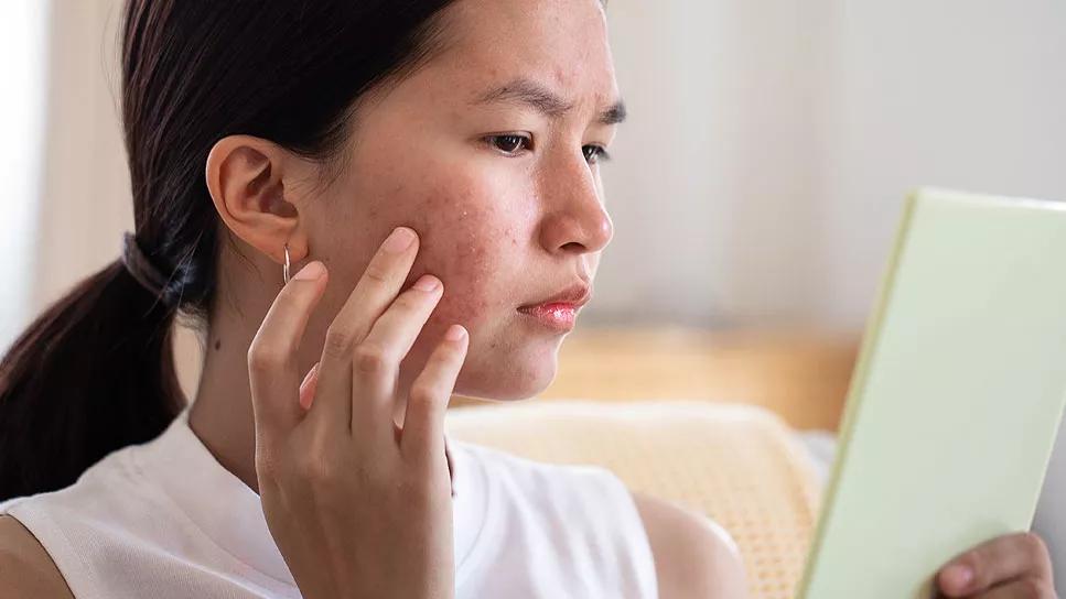 Person touching acne on face while looking in handheld mirror