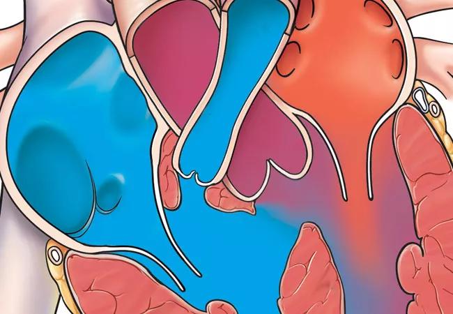 19-HRT-3920_tetralogy of Fallot-650&#215;450