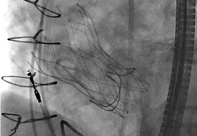 New AUC Document Gives a Multimodality Take on Imaging in Valvular Heart Disease