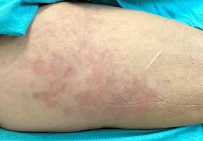 Mixed connective tissue disease rash