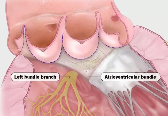 21-HVI-2061014_left-bundle-branch-atrioventircular-bundle_650x450