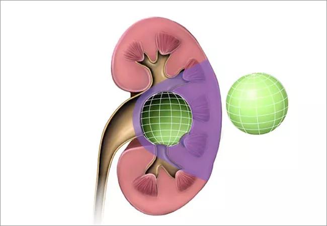 650x450exophytic tumors