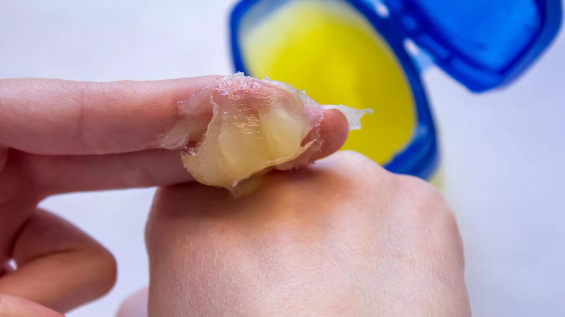 Petroleum jelly being applied to a hand