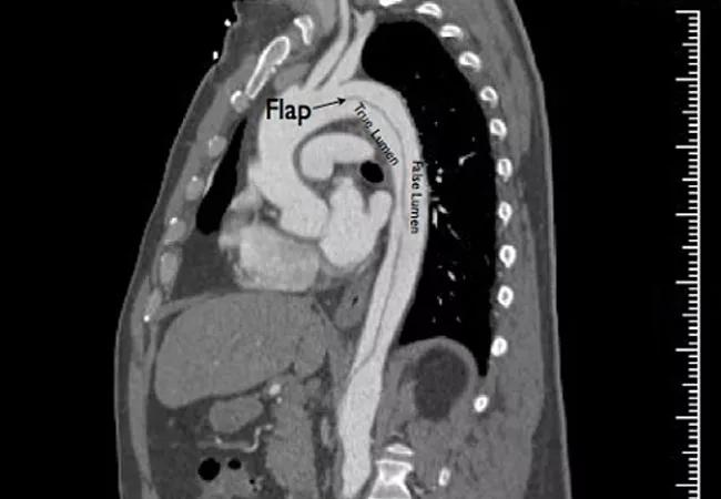 16-HRT-1024-TypeB-Aortic-Dissection-CQD-650&#215;450