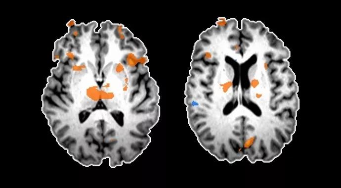 690&#215;380-Machado-Thalamic