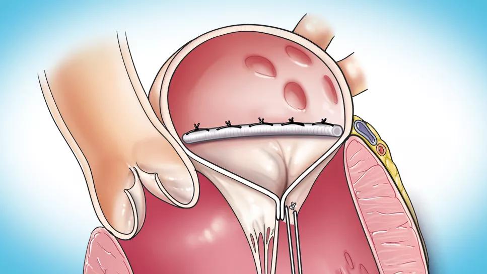 completed mitral valve repair