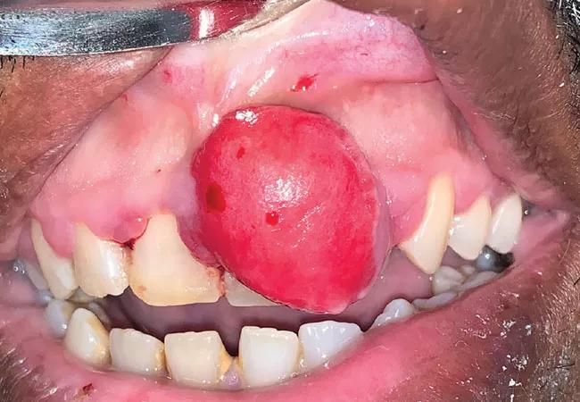 Gingival fibroma