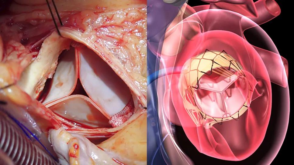 side-by-side photo and illustration of bioprosthetic heart valves