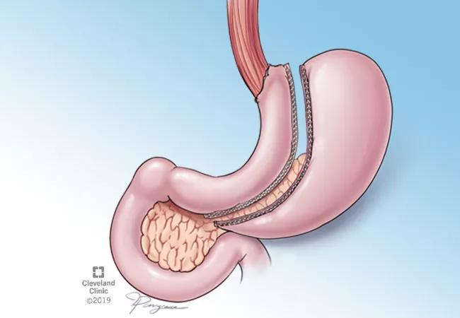 sleeve gastrectomy