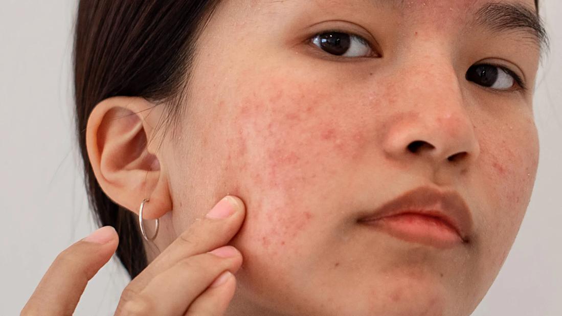 Person examining their scarred and acne-prone face skin