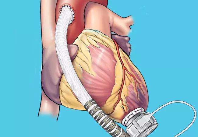 20-HVI-1925363-LVAD-650&#215;450