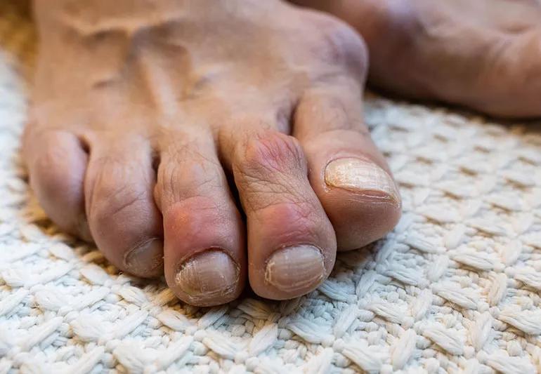 Closeup of a foot with gout, including swollen, crooked toes and damaged toenails