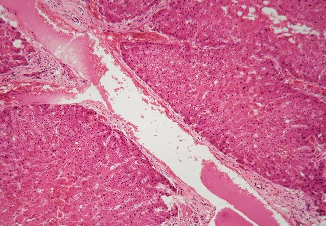 Human liver tissue with Amyloidosis under a microscope.