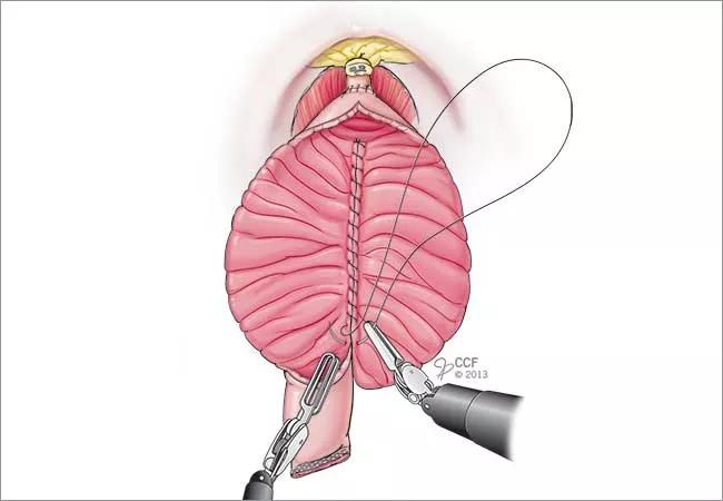 650&#215;450-Haber-Bladder